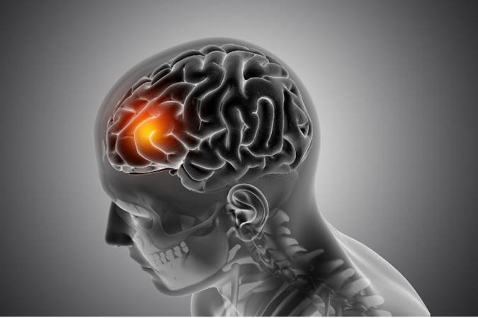Brain Tumour: Traditional and Latest Treatments