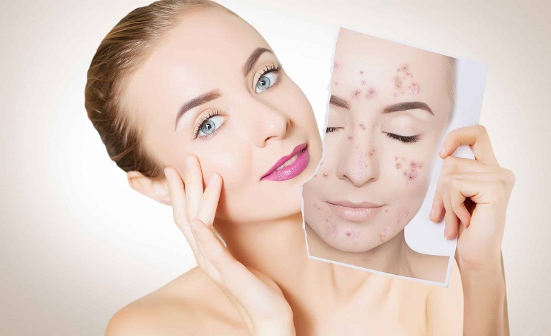 Say Goodbye to Scars: Dubai Acne Scar Solutions