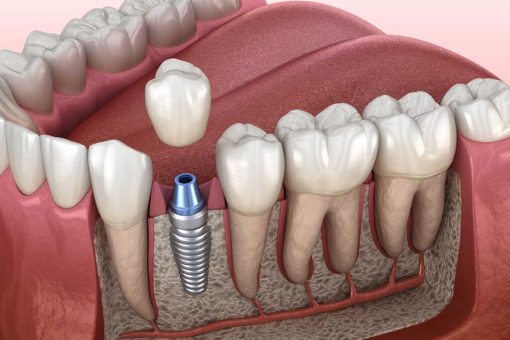 Why These Clinics Are Leading in Dental Implants