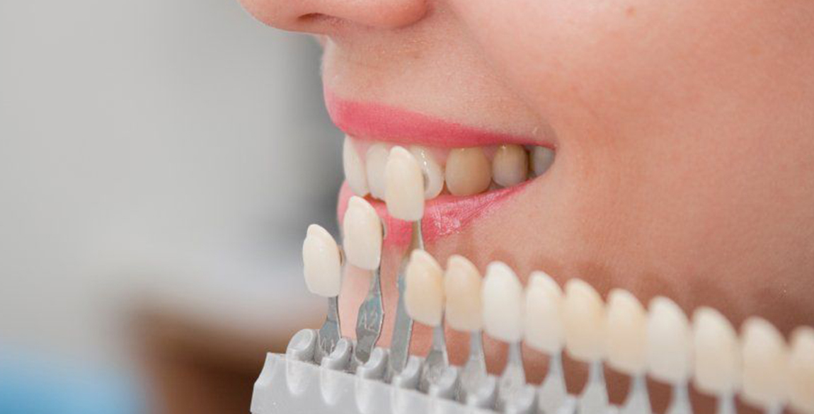 Dental Veneers Cost vs Benefits: Worth the Investment