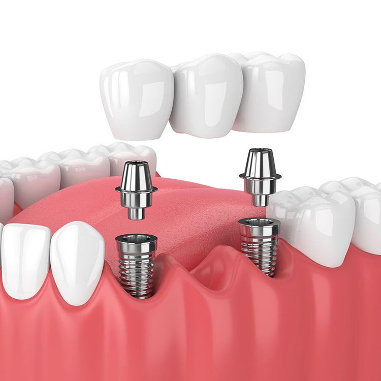 Implant Supported Bridge In Mulund - Niraamay Dental Care
