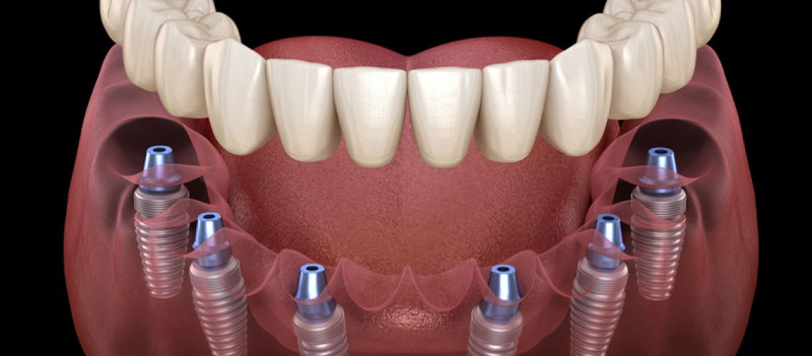 The Benefits of Full Mouth Implants Over Traditional Dentures in Mulund