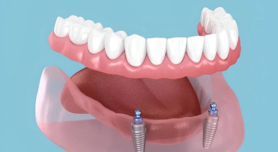 Step-by-Step Process of Getting Implant Supported Dentures in Mumbai