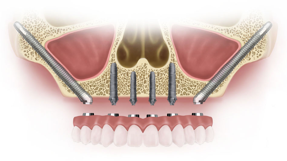 Zygomatic Implants in Mulund: The Best Treatment for Severe Tooth Loss