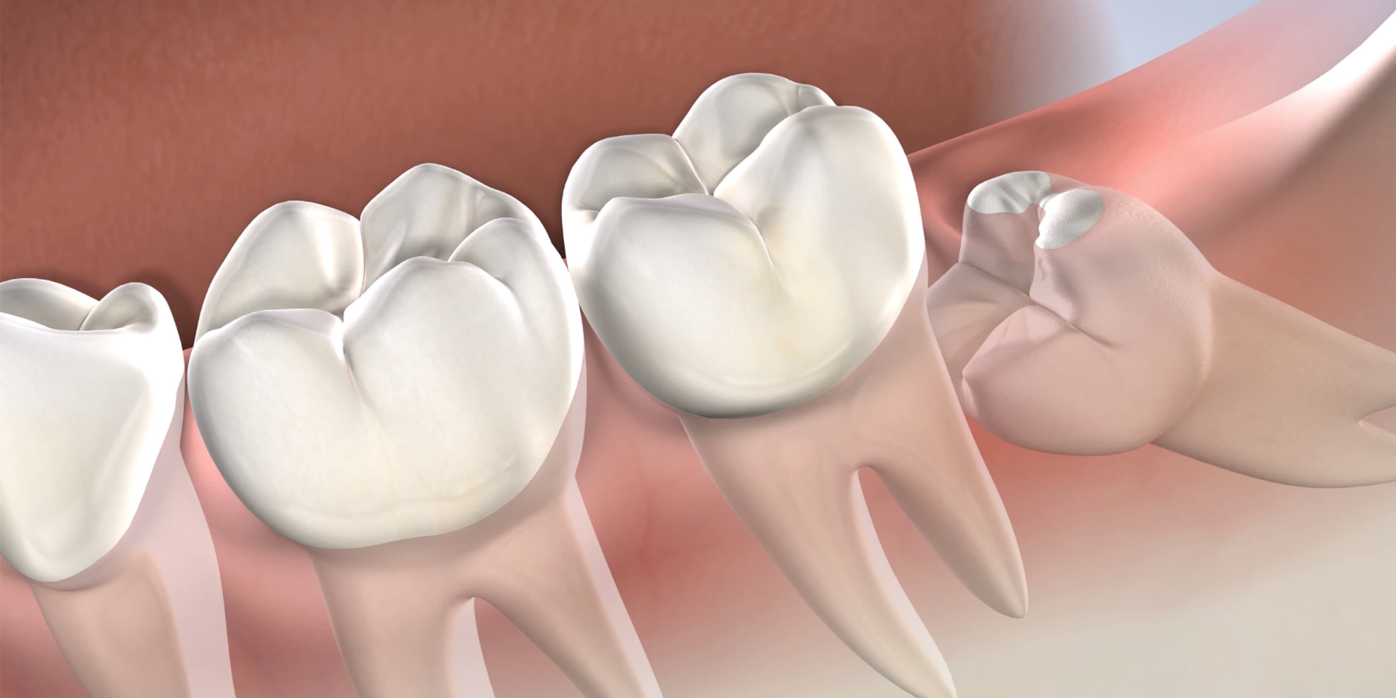 Recovery Tips After Wisdom Tooth Removal Treatment in Mulund
