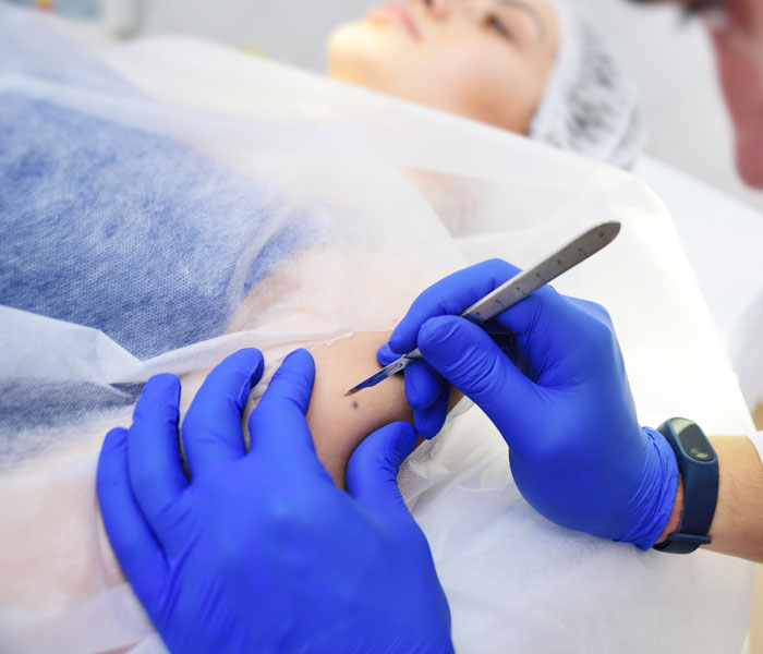 Global Skin Excision Market driven by increasing prevalence of skin cancer 
