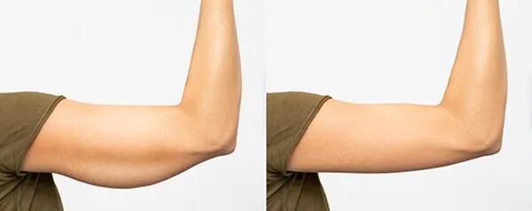 Avail Transformative Arm Fat Reduction Solutions at Good Price