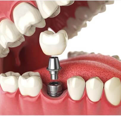Dental Implants Service in Gurgaon, Dental Implants Doctors in Gurgaon