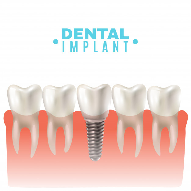 Reasons to Check out Tooth Implants San Diego