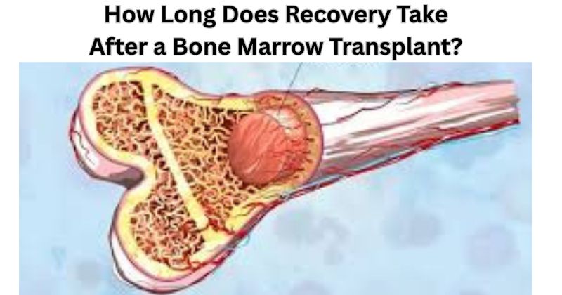 How Long Does Recovery Take After a Bone Marrow Transplant?