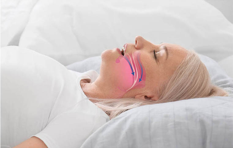 A Comprehensive Guide on How to Treat Sleep Apnea