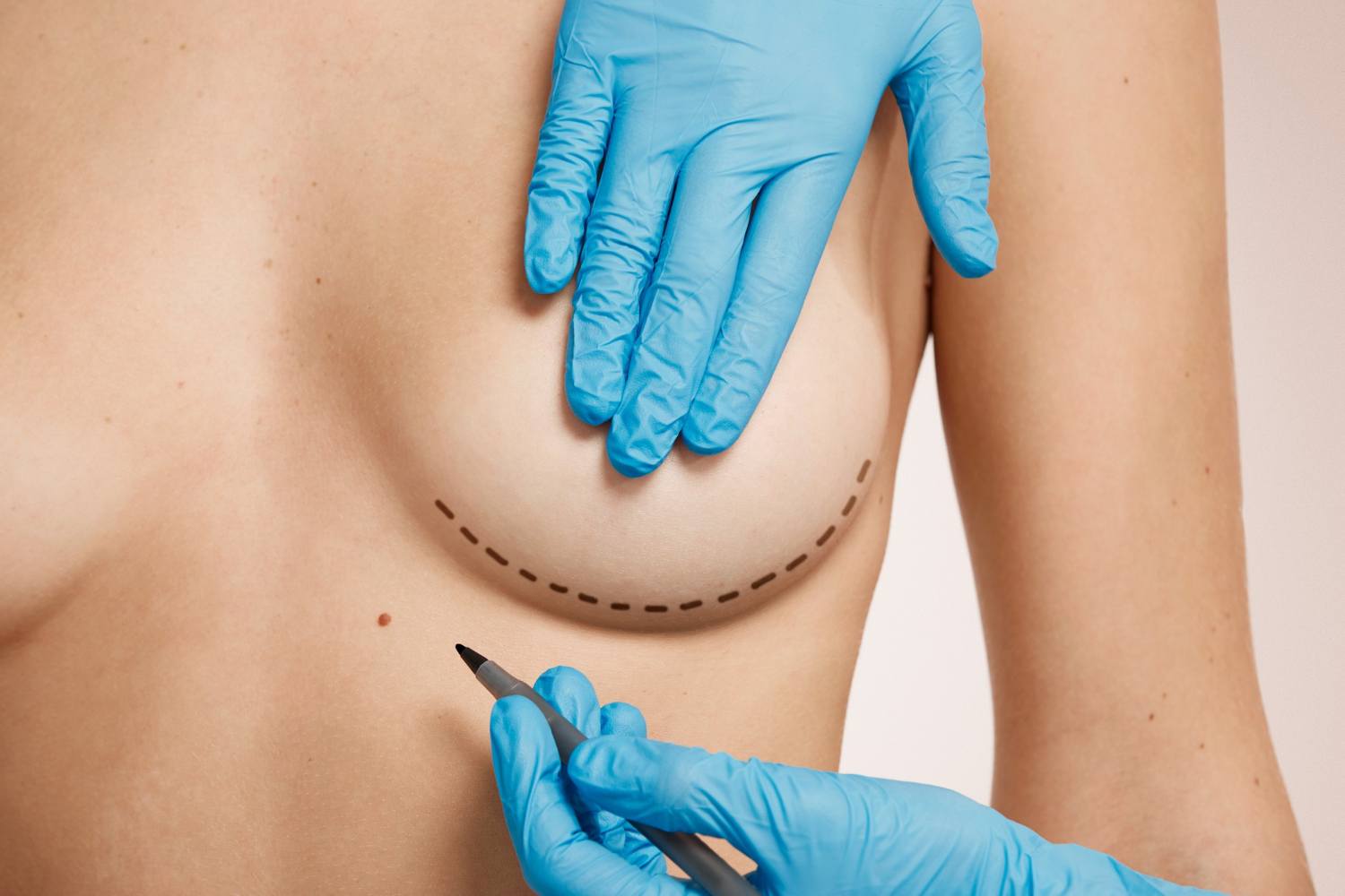 Fat Transfer Safety: Is Fat Transfer Breast Augmentation Safe?