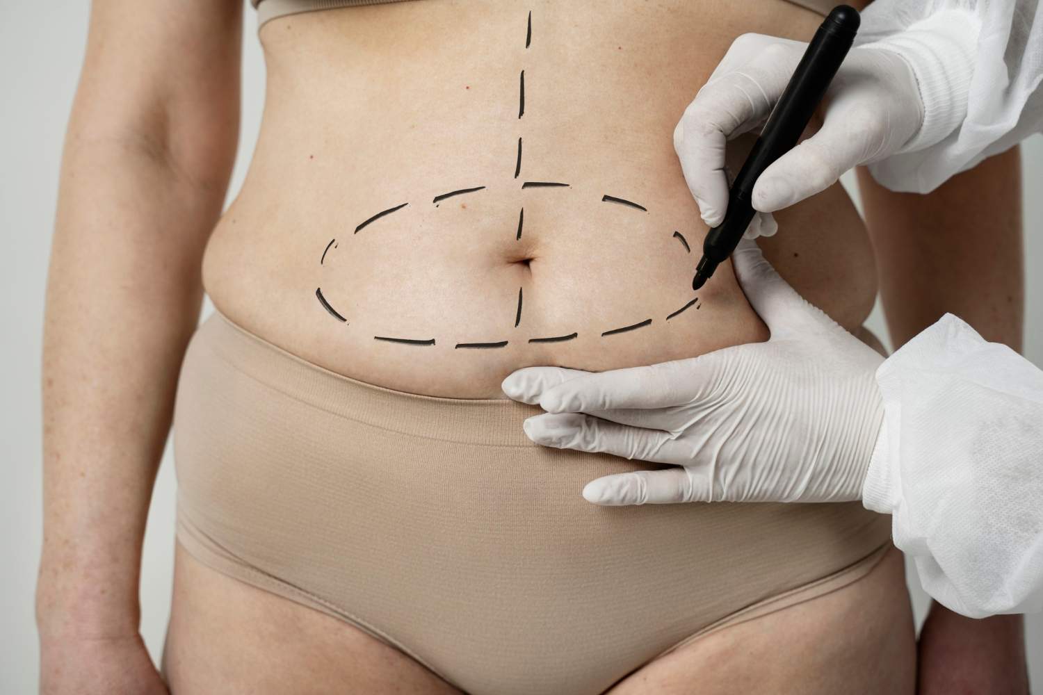 Is Liposuction 100% Safe? Knowing the Pros and Cons
