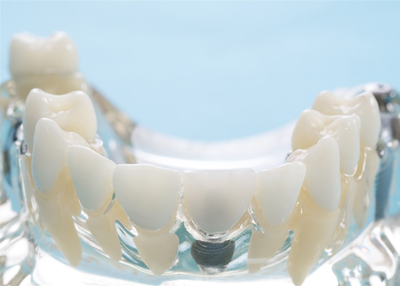 4 Signs You Should Get a Dental Crown ASAP