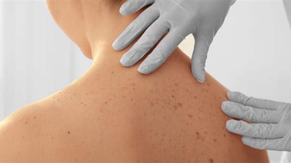 The Global Merkel Cell Carcinoma Market is Anticipated to Witness Steady Growth Due to Increasing Incidence of Skin Cancers