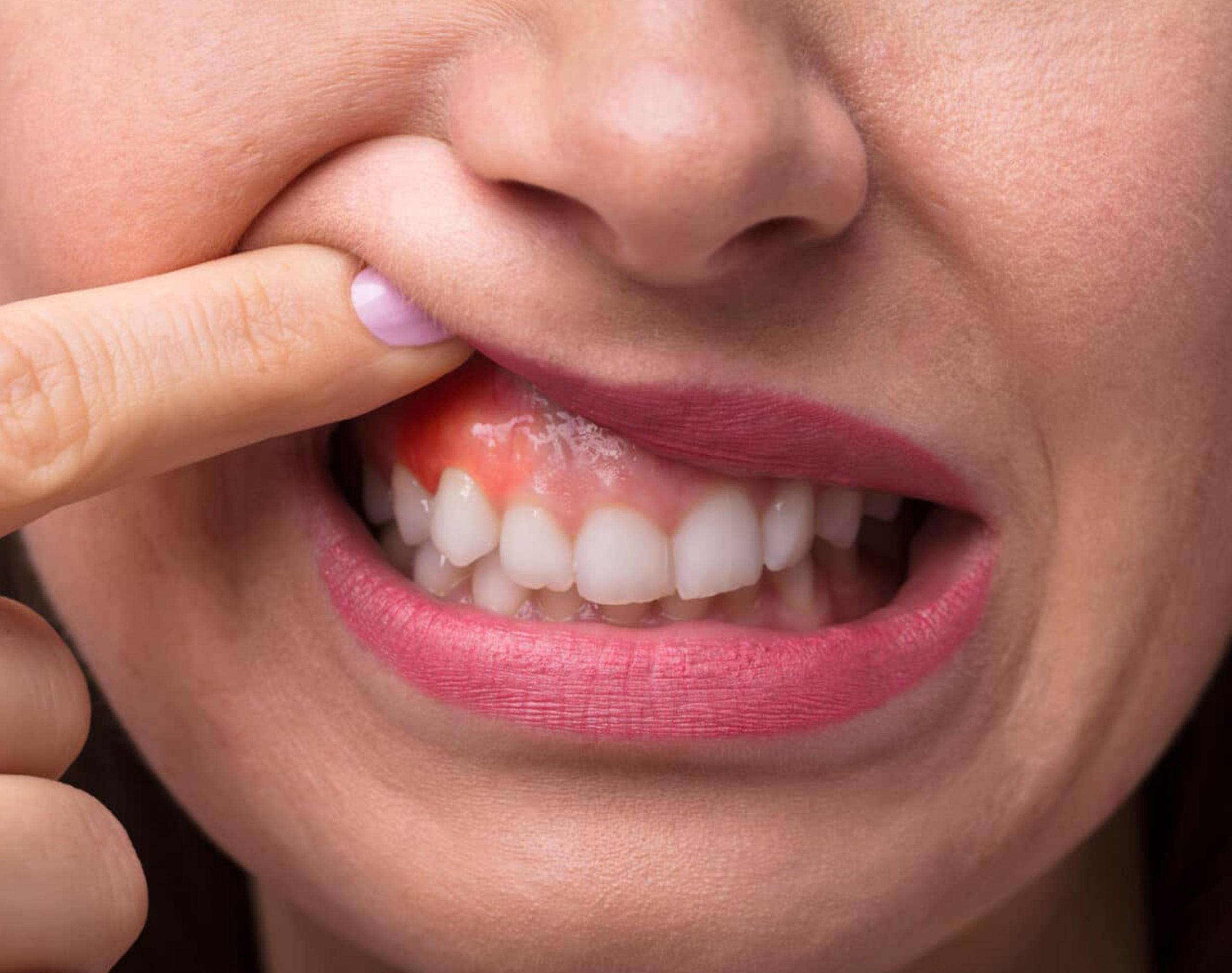 The Global Gingival Recession Market is Anticipated to Witness Robust Growth owing to Rising Prevalence of Periodontal Diseases