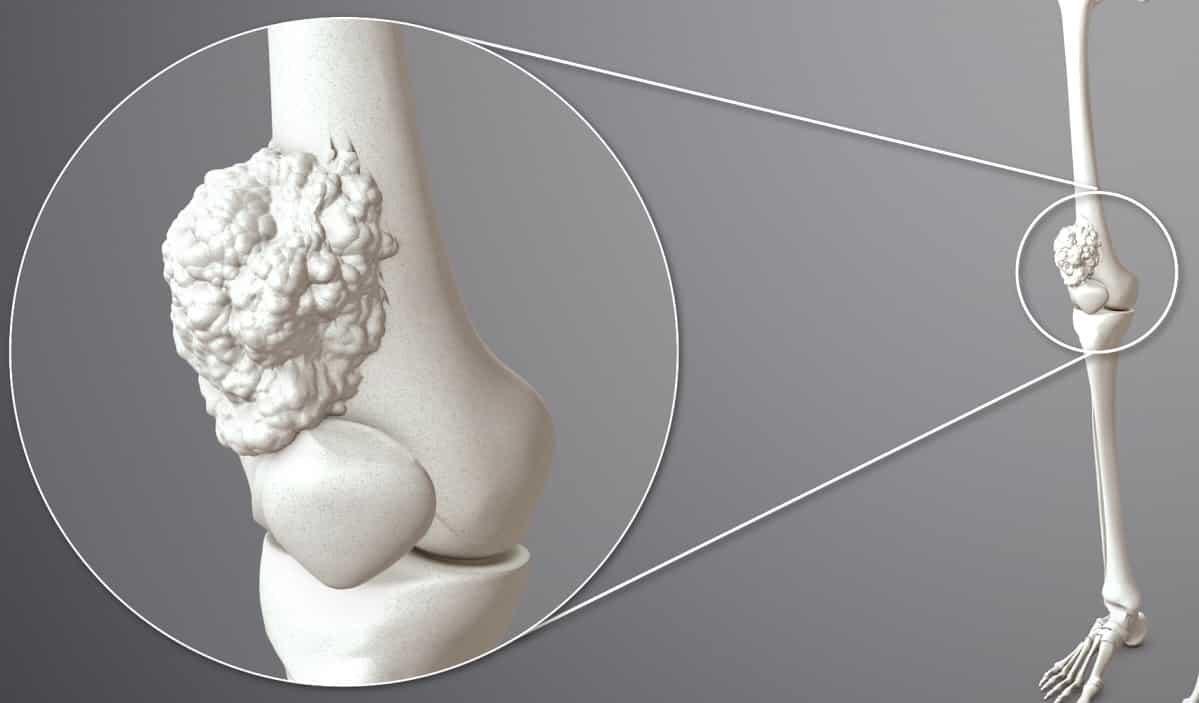 Bone Metastasis in Solid Tumors Market Set for Solid Growth Owing to Increasing Incidence of Bone Metastasis