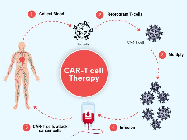 How CAR T-Cell Therapy Revolutionizes Cancer Treatment