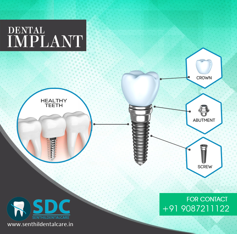 Best Dental Implant Clinic Services, Dental Implant In Chennai