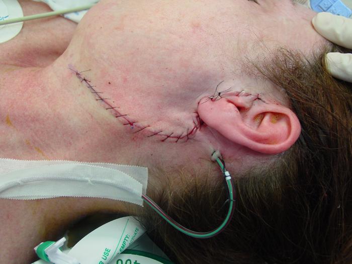 Parotidectomy Surgery in India | Healing Touristry