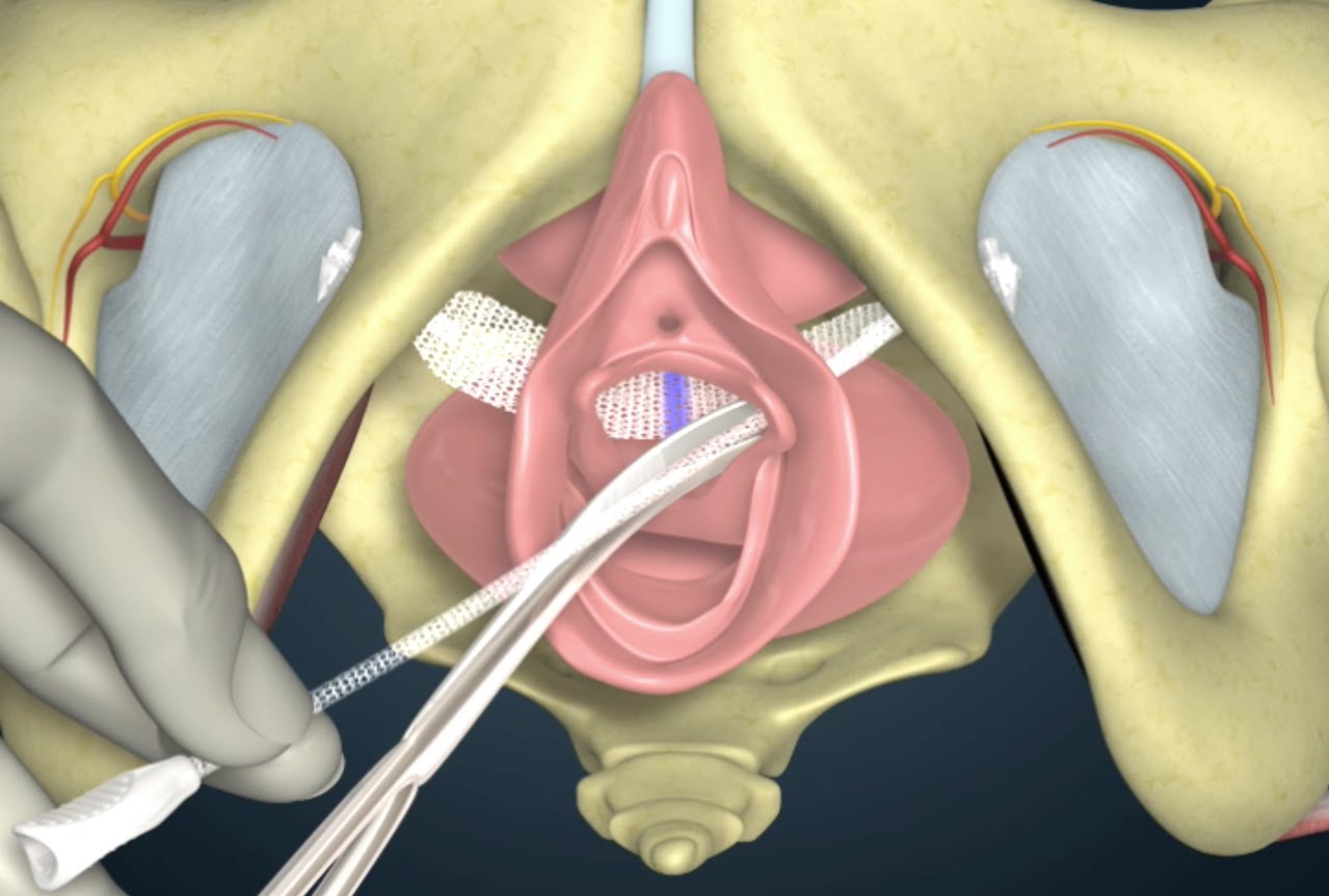Bladder Slings Treatment in India