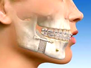 Oral and Maxillofacial Surgery in India | Healing Touristry