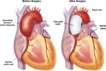 Aortic Dissection Repair Surgery in India | Healing Touristry