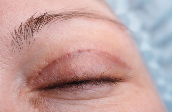 Best Eyelid Surgery in India | Healing Touristry