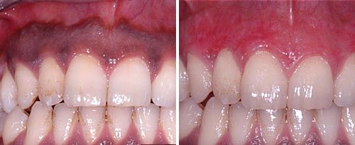 Laser Gum Depigmentation Gum Bleaching Treatment in India | Healing Touristry