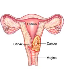 Uterine Cancer Treatment in India | Healing Touristry