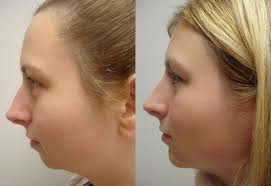 Do you know about Chin Implant Surgery?
