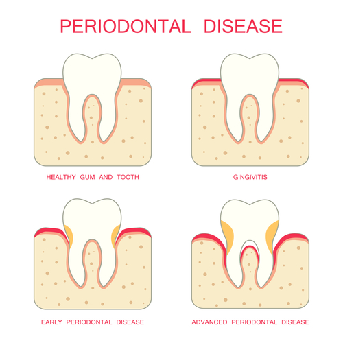 Know About Periodontal Diseases Treatment in India