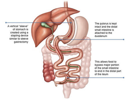 Laparoscopic Biliopancreatic Diversion Surgery in India