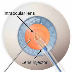Intraocular Implants Surgery in India | Healing Touristry