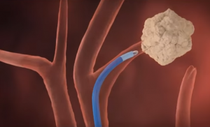 Bronchoscopy Procedure Treatment in India | Healing Touristry