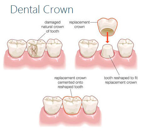 Dental Crowns and Caps Procedure Treatment in India