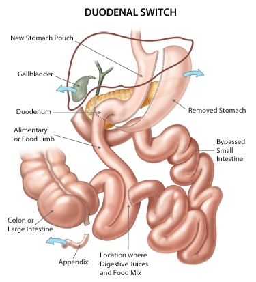 Duodenal Switch Treatment in India | Healing Touristry