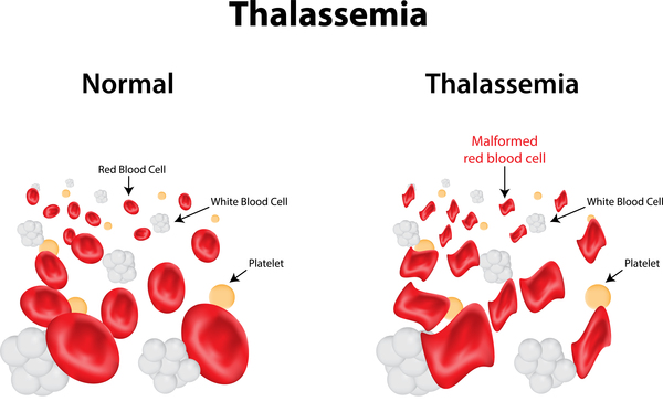 Best Thalassemia Treatment in India - Healing Touristry