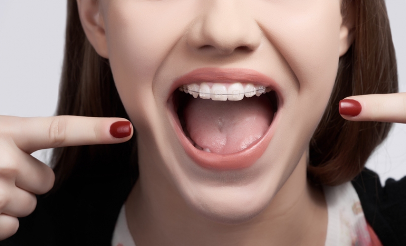 Lingual Braces Treatment in India | Healing Touristry