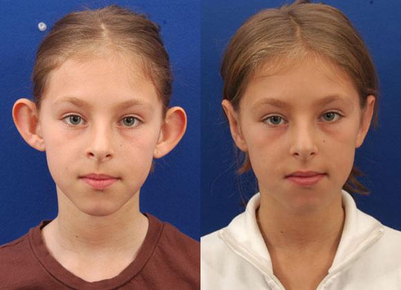 Do you know about Otoplasty Surgery?