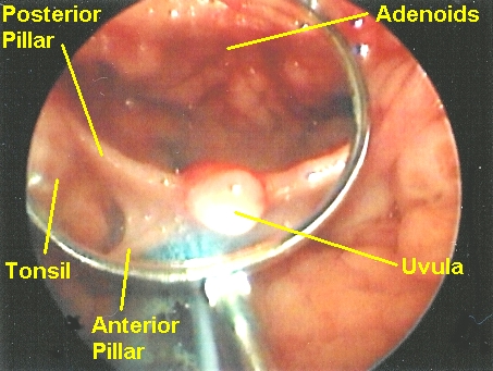 Do you know about Nasopharyngoscopy Procedure?