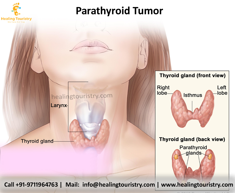 Parathyroid Tumor Treatment in India - Healing Touristry