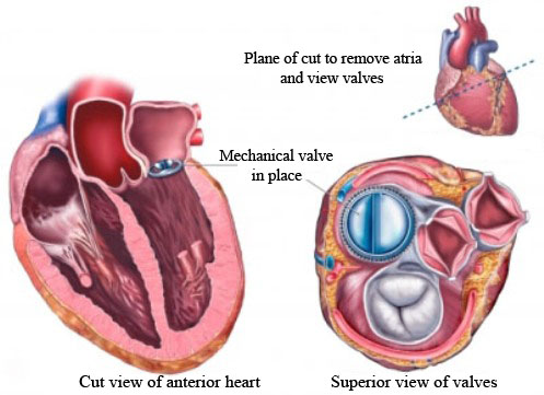 Surgery for Mitral Valve Replacement in India | Healing Touristry