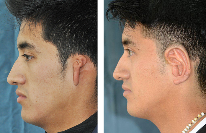 Best Hospitals for Microtia Surgery in India | Healing Touristry
