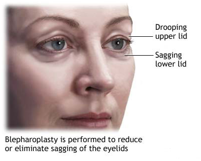 Blepharoplasty Eyelid Surgery | Healing Touristry
