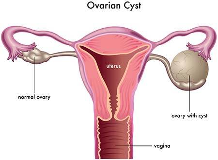 Best Doctors for Ovarian Cyst Removal Surgery in India