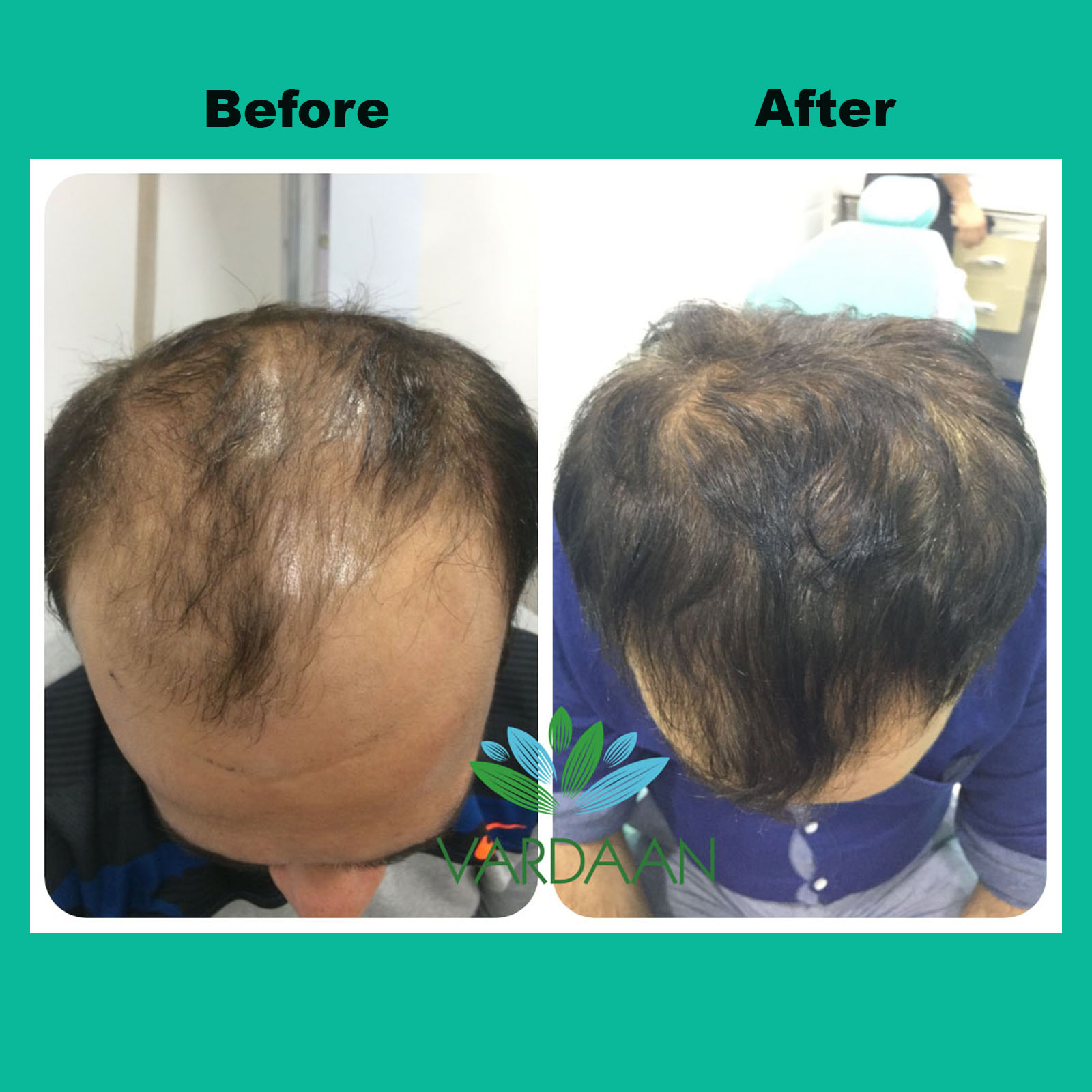 PRP for Hair Fall