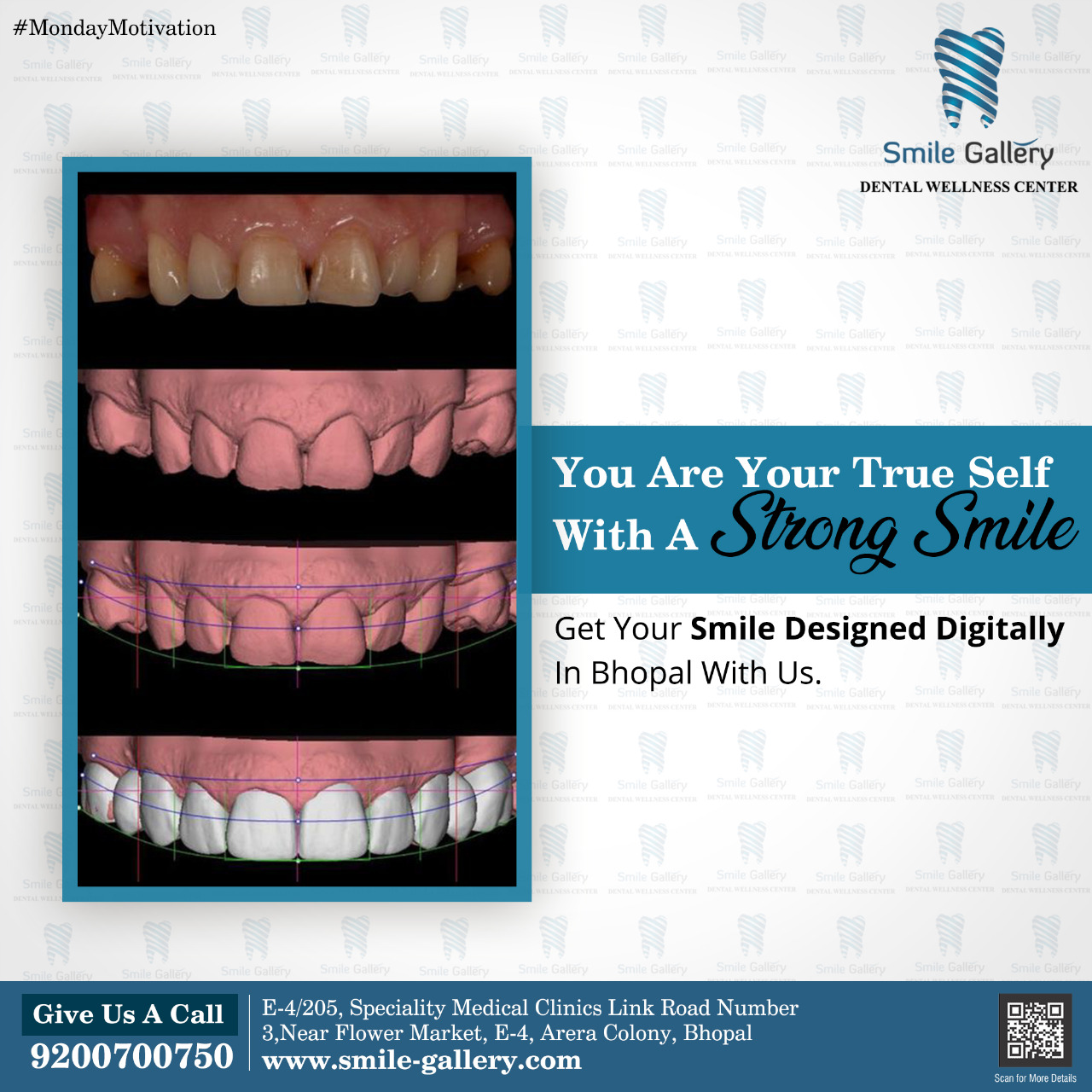 Low cost dental impalnts in bhopal