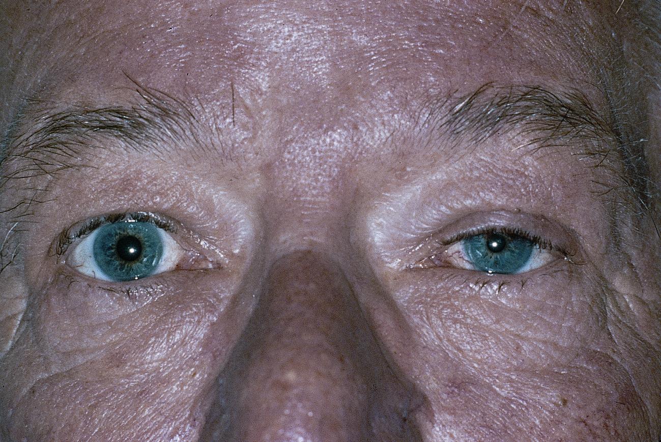 Muckle Wells Syndrome Treatment Market Will Grow Rapidly Due to Rising Research and Development 