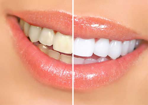 Smile Makeover in Delhi - Dentedgeclinic